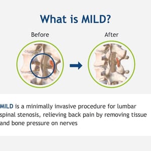 MILD Procedure