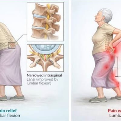 Lumbar Spinal Stenosis with Neurogenic Claudication