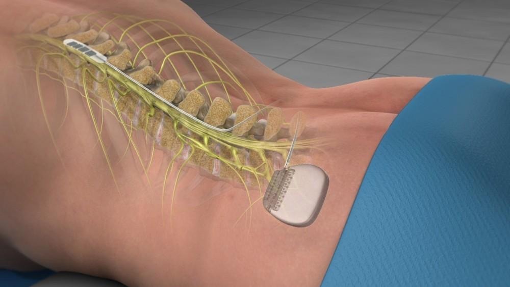Spinal cord stimulator implant device illustration showing lead placement along the spine