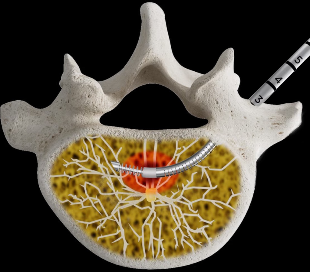 ViaVerte™ basivertebral nerve ablation anatomical illustration